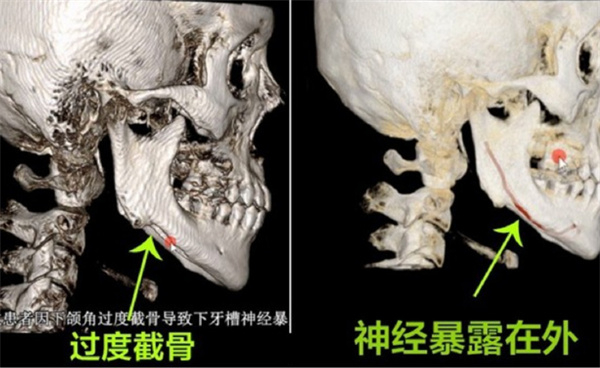 重庆华美潘宝华磨骨怎么样