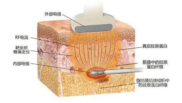 激光溶脂