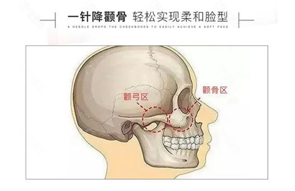 广州一针降颧骨的医院是哪家?广州曙光医学美容医院做的不错
