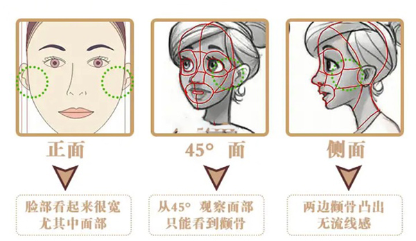 广州一针降颧骨的医院是哪家?广州曙光医学美容医院做的不错