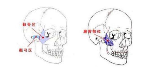 广州一针降颧骨的医院是哪家?广州曙光医学美容医院做的不错