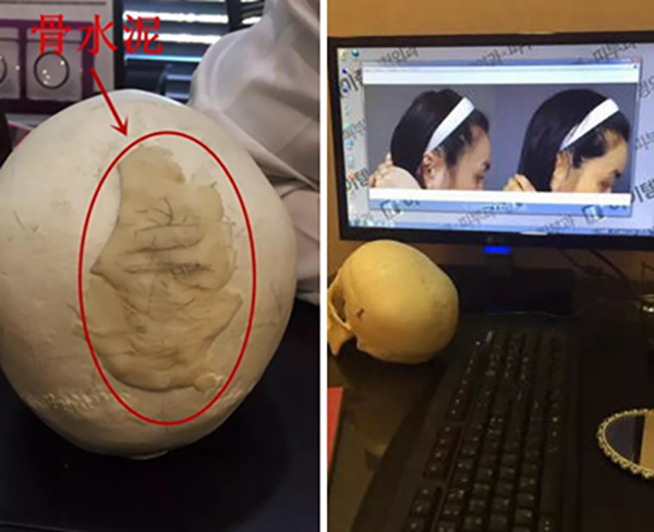 韩国雕刻整形医院骨水泥填充后脑勺