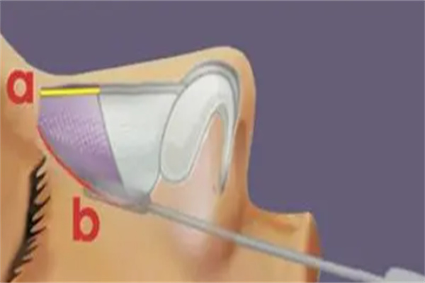 广州做鼻子较好的医生对比:隆鼻找蒋思军和高顺福谁厉害附价格