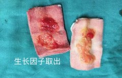 记录我的生长因子取出经历,生长因子取出来的图片真的吓人