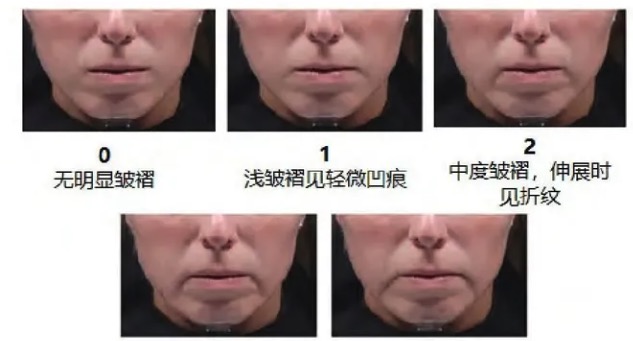 口角囊袋下面部松弛下垂咋办?口周年轻化注射方法真的很推荐