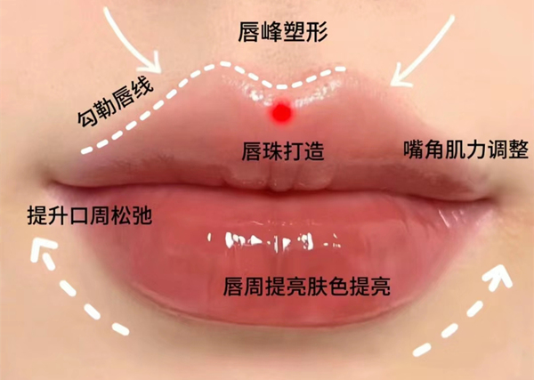 打嘟嘟唇用什么玻尿酸哪个牌子好?瑞蓝/乔雅登/伊婉/姣兰