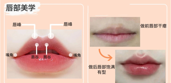 打嘟嘟唇用什么玻尿酸哪个牌子好?瑞蓝/乔雅登/伊婉/姣兰