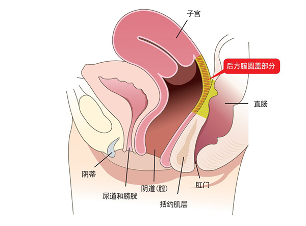 韩国好手艺阴道紧缩（后方膣圆盖术）手术