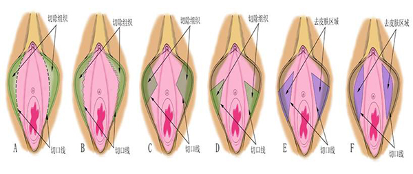 好手艺小阴唇手术