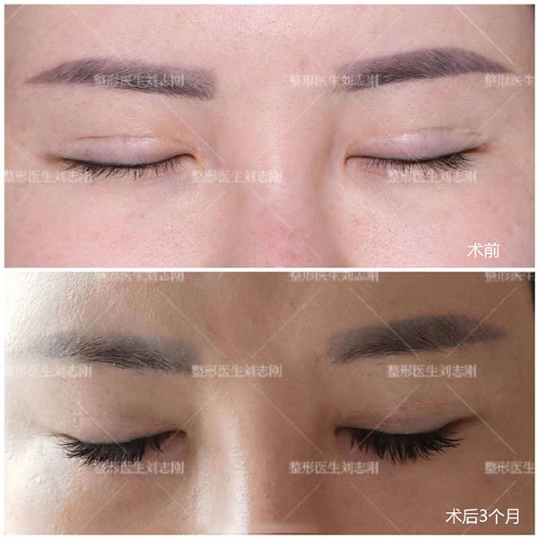 刘志刚眼修复到底咋样?他擅长板结肉条眼修复/闭眼疤痕/眼窝凹陷等手术