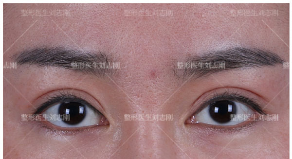 刘志刚眼修复到底咋样?他擅长板结肉条眼修复/闭眼疤痕/眼窝凹陷等手术