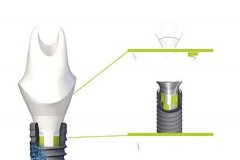 种植牙可以走医保报销吗?2024种植一颗牙需要多少钱附价格表