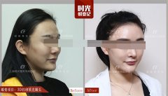 国内外骨水泥填充头型价格：含后脑勺|高颅顶|额头费用和靠谱医院名单