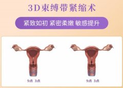 3d生物束带紧缩术后真的有成果吗？术后要多久能同房？