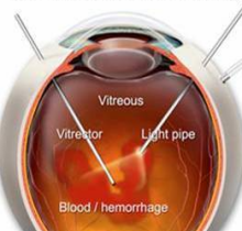 玻璃体切割术是什么意思?请告诉我玻璃体切割后还能长出来吗?