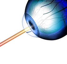 1000度近视眼可以做手术吗？大概多少钱？能做激光手术吗