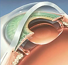 白内障晶体植入后多久能修复视力？一些术后注意事项应留意