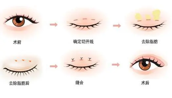 美杜莎双眼皮是全切还是埋线