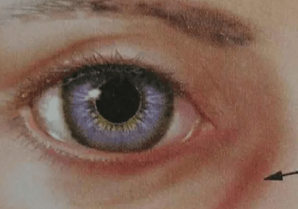 眼轮匝肌重建术