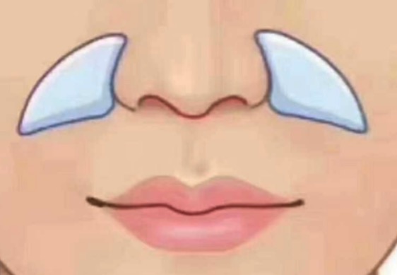 鼻基底凹陷填充用什么材料好？来看这几种填充材料的优缺点都有哪些