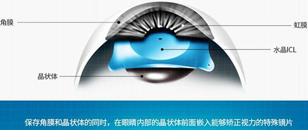 icl晶体植入术的优点和缺点有哪些？大概要多少钱
