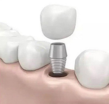 韩国科威尔种植牙多少钱一颗怎么样？价格不贵和登腾哪个好呢