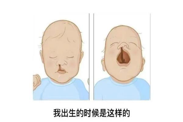 先天性唇腭裂