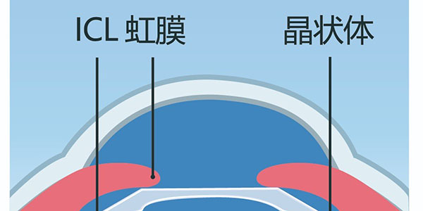icl晶体植入手术术后注意事项有哪些？需要休息多久