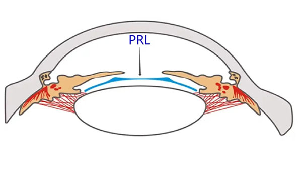 prl晶体植入的利与弊有哪些？和激光手术哪个好