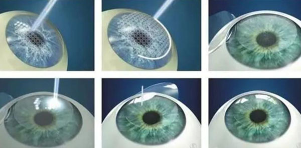 800度近视可以做激光手术吗?飞秒激光和晶体植入的优缺点有哪些