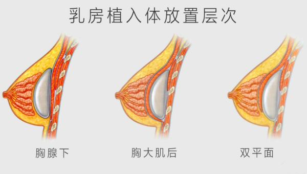 乳房植入体放置层次