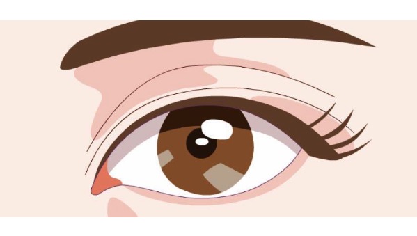 开眼角没开好可以二次重开吗?可以来看开眼角手术的优势及适应人群