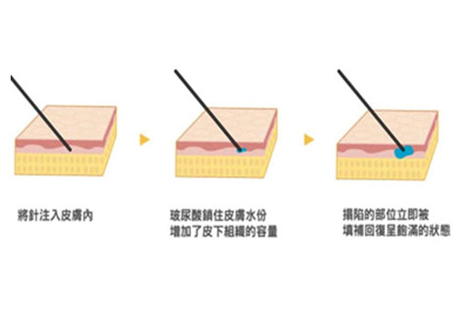 玻尿酸多少钱一支