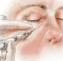 泪沟填充玻尿酸好还是胶原蛋白好?泪沟填充后两年有硬块怎么办?