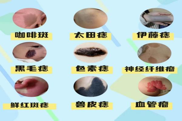 激光去胎记后需要注意什么