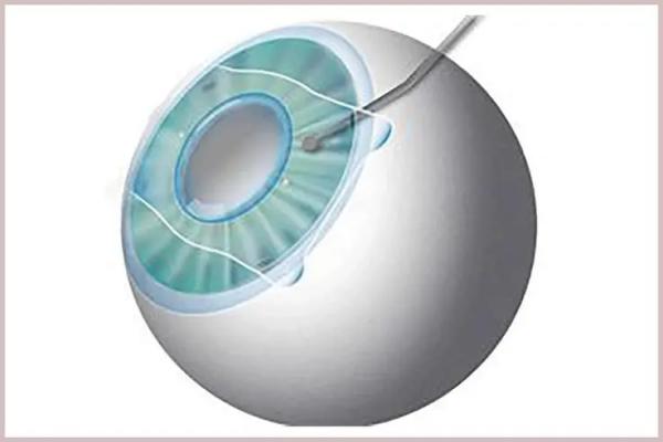 华西医院眼科怎么样?华西医院眼科邓应平等医生简介及坐诊时间公布