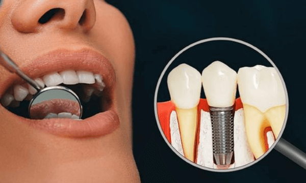 合肥新安口腔医院种植牙收费标准