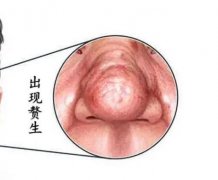 酒糟鼻可以用光子嫩肤治疗吗?