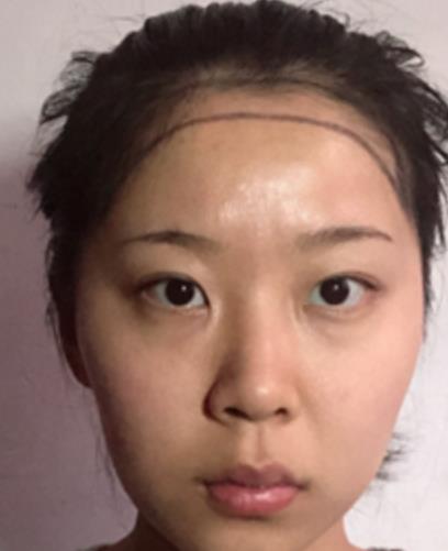 徐州三院植发靠谱吗？三甲医院技术真不赖！