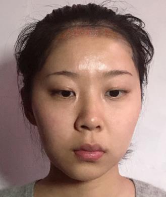 徐州三院植发靠谱吗？三甲医院技术真不赖！