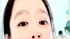 7d聚拉提可以做眼睛吗?做完后注意事项?