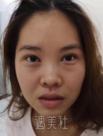 华西去眼袋手术多少钱呢？好不好？真实对比图片