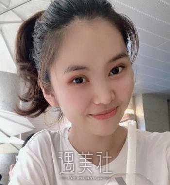 华西去眼袋手术多少钱呢？好不好？真实对比图片