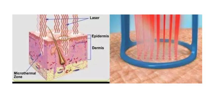 点阵激光2.jpg 点阵激光2.jpg