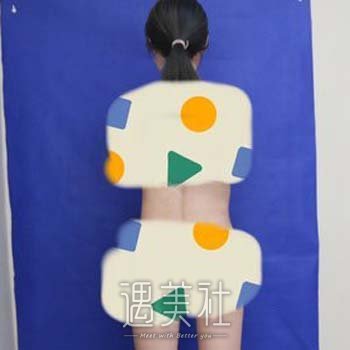 北京协和医院抽脂大概多少钱？成果好不好？抽脂减大腿实例