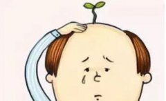 植发6个月与一年的密度对比:过了脱发期之后头发茂密生长~