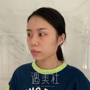 南华大学附属第二医院割双眼皮多少钱？哪位医生好？附实例