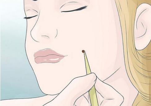 祛痣动漫01.jpg 祛痣动漫01.jpg