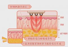 做热玛吉有什么反应?