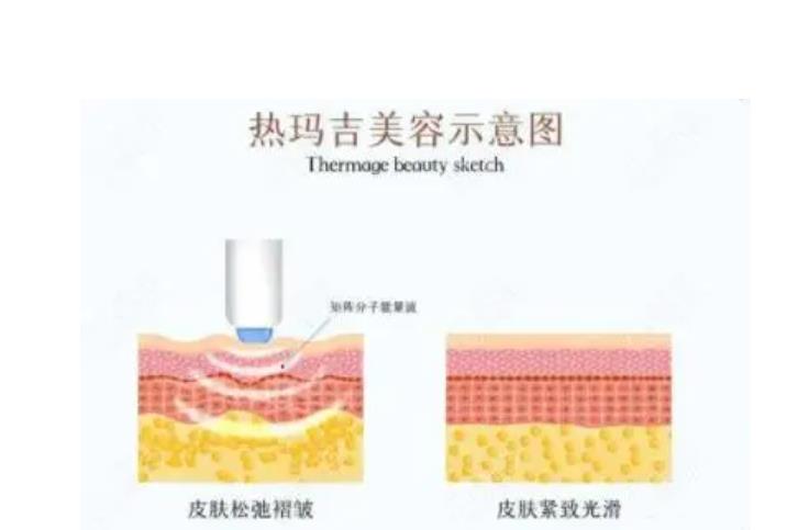 做热玛吉痛苦吗?热玛吉有哪些作用